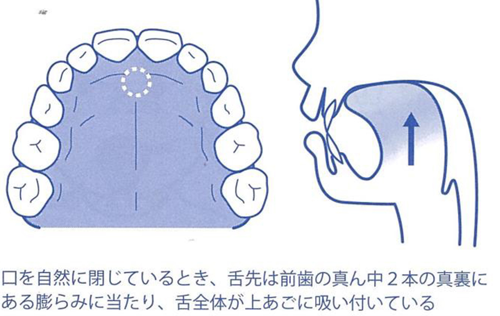 舌の位置が不正咬合を誘発している可能性も