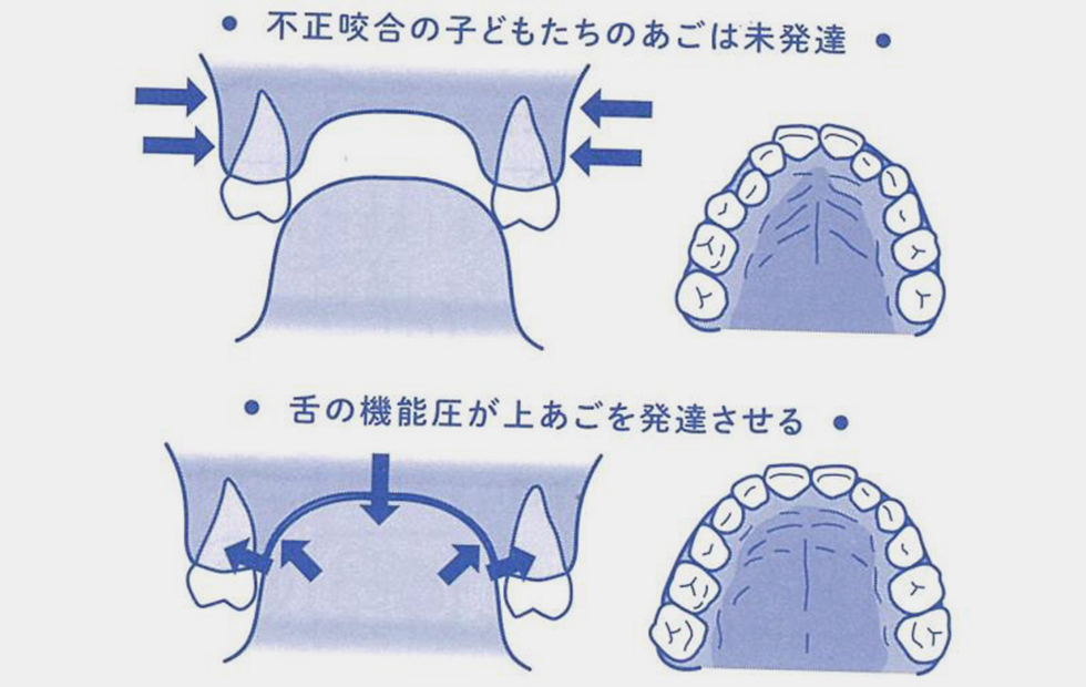 お口の活動が不正咬合に影響します