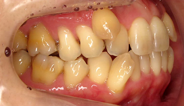 歯のガタガタを治療した症例 Before