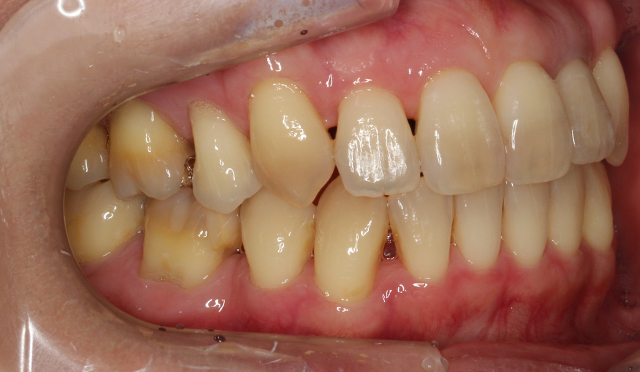歯のガタガタを治療した症例 After