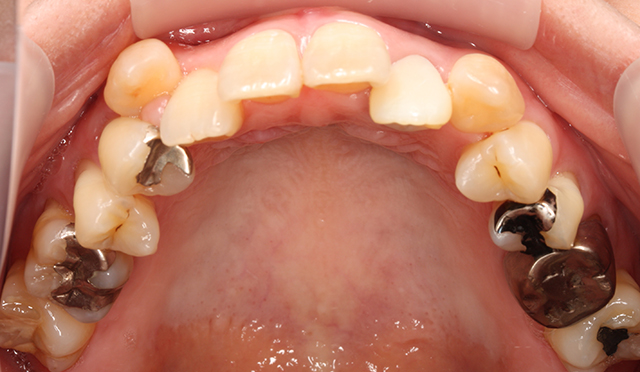 歯のガタガタを治療した症例 Before