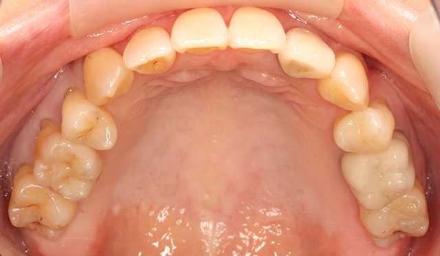 歯のガタガタを治療した症例 After